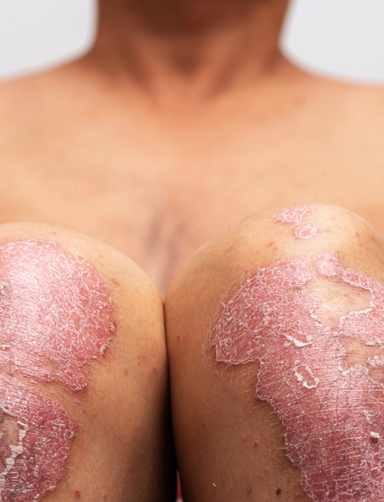 Dermatólogo Especialista en Psoriasis - El Albir, Alfaz del Pi, Alicante | DerMar Dermatology