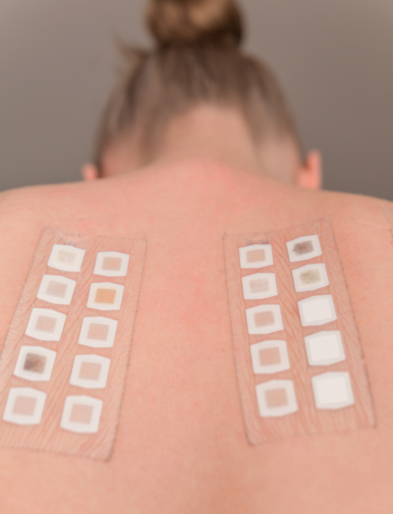 Pruebas Epicutáneas - Patch Test - El Albir, Alfaz del Pi, Alicante | DerMar Dermatology