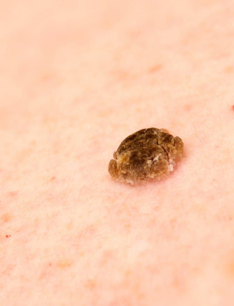 Eliminar Queratosis Seborreica - El Albir, Alfaz del Pi, Alicante | DerMar Dermatology