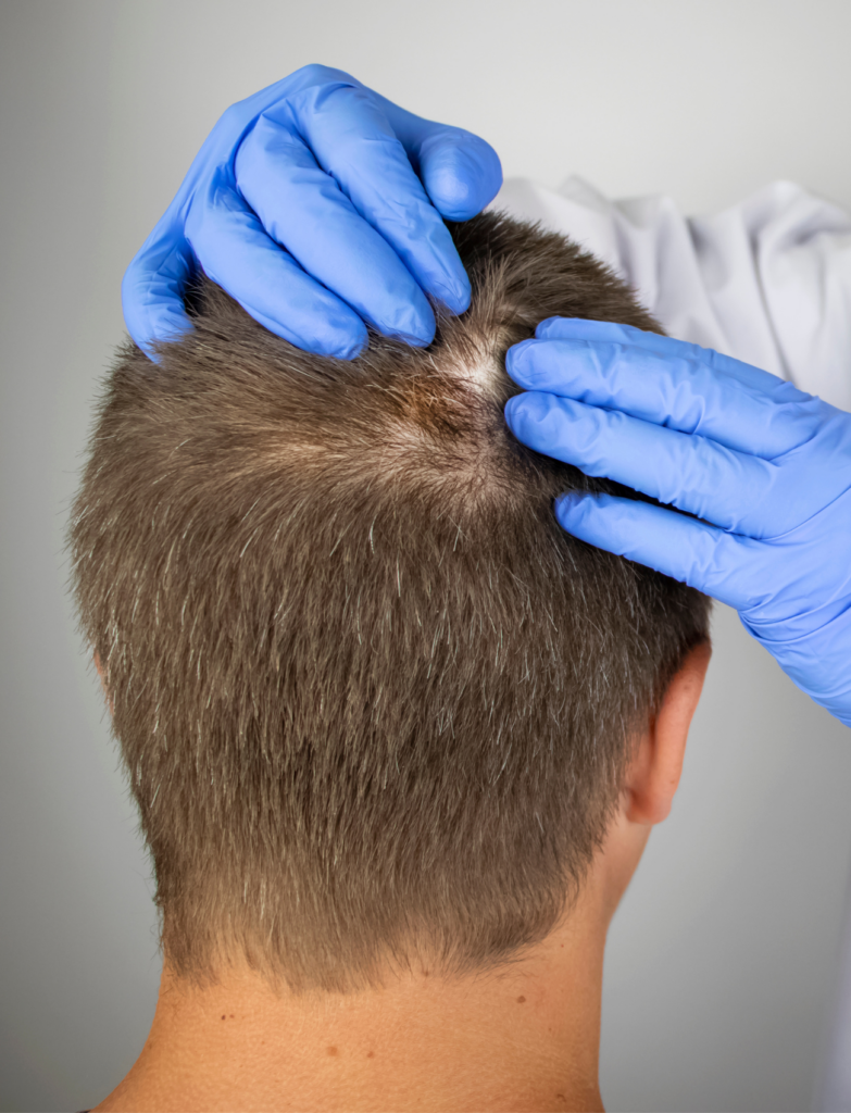 Tratamiento de la Alopecia Androgénica - El Albir, Alfaz del Pi, Alicante | DerMar Dermatology