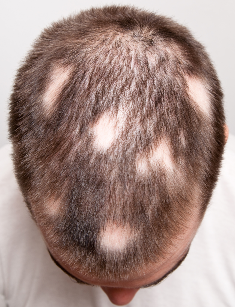 Tratamiento de la Alopecia Areata - El Albir, Alfaz del Pi, Alicante | DerMar Dermatology