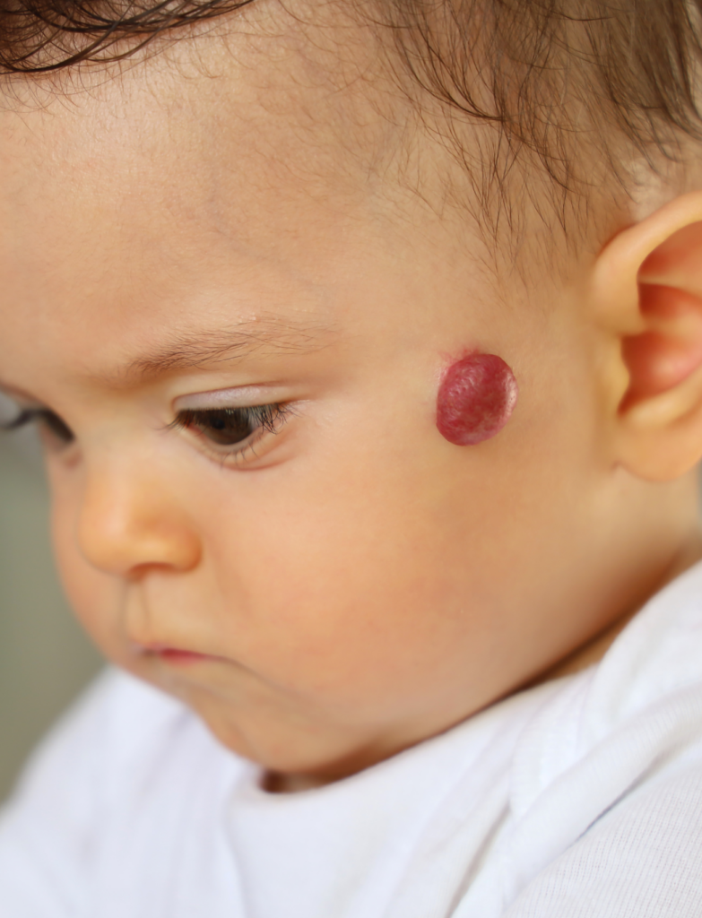 Dermatólogo Especialista en Hemangiomas Infantiles - El Albir, Alfaz del Pi, Alicante | DerMar Dermatology