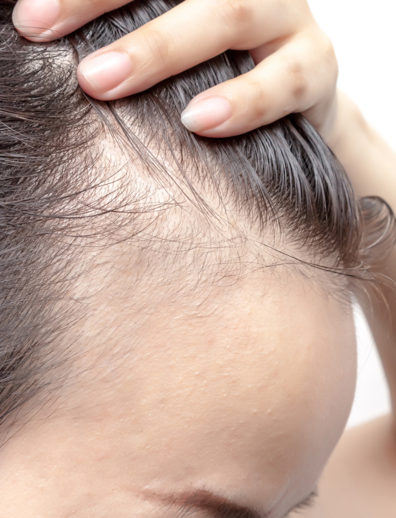 Tratamiento de la Alopecia Frontal Fibrosante - El Albir, Alfaz del Pi, Alicante | DerMar Dermatology